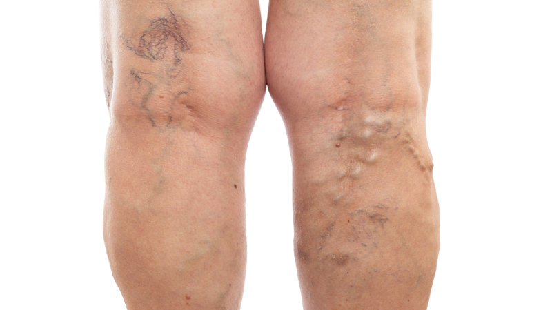 Explore Varicose Vein Treatment in Hamilton, NJ