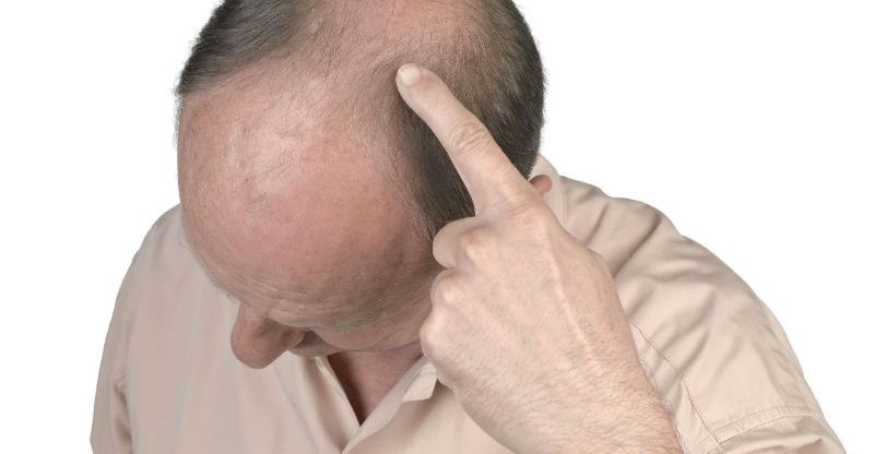 Utilize an FUE Hair Transplant in Pennsylvania To Fill in Bald Areas